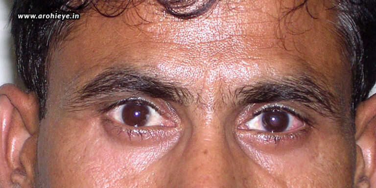 cost-of-squint-eye-surgery-in-india-squint-specialist-in-mumbai