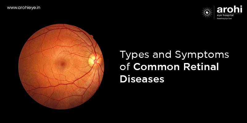 Retinal Diseases: Types, Causes, Symptoms, Treatment, Outlook